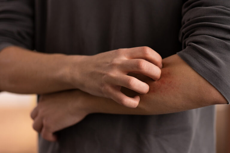 eczema hypnose paris
